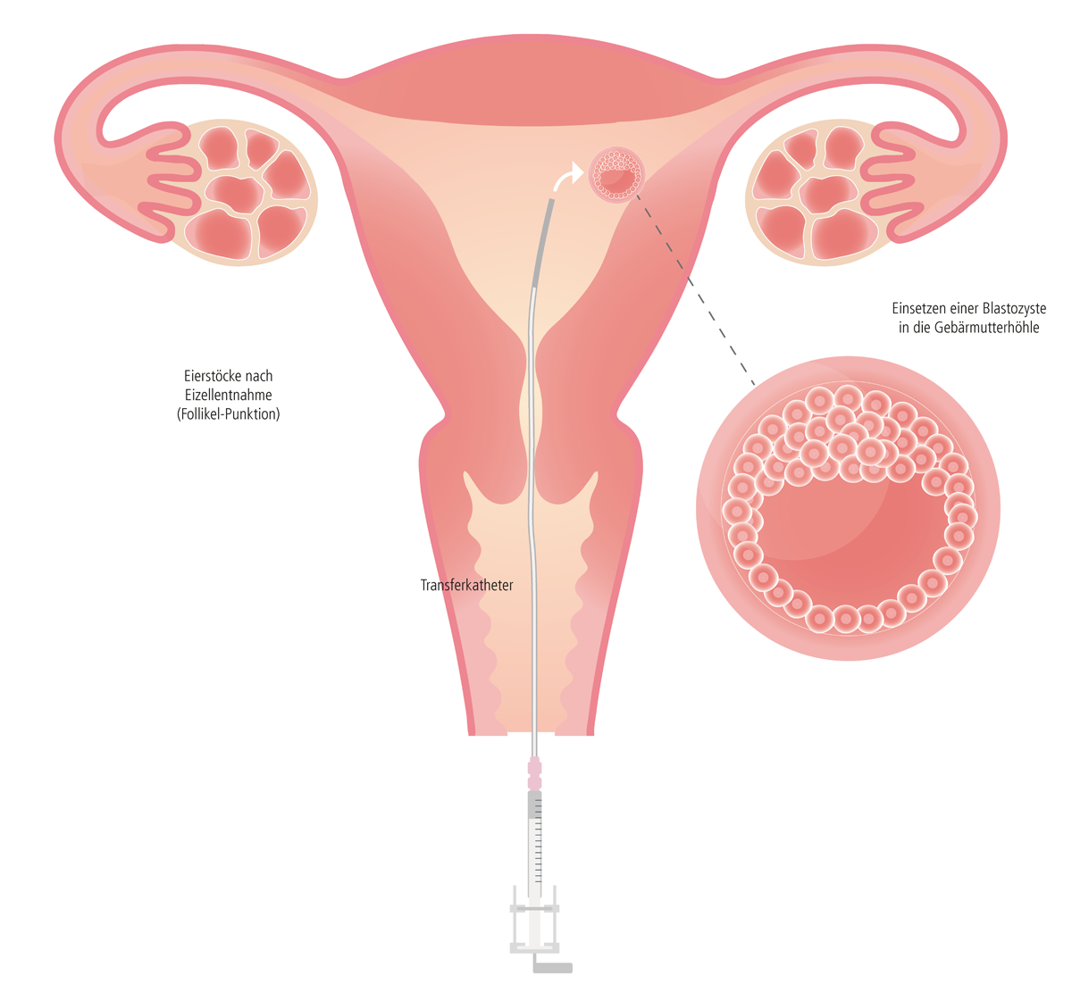 Schematische Darstellung des Embryo-Transfers bei einer Kinderwunschbehandlung │ © 2021 Next Fertility IVF Prof. Zech