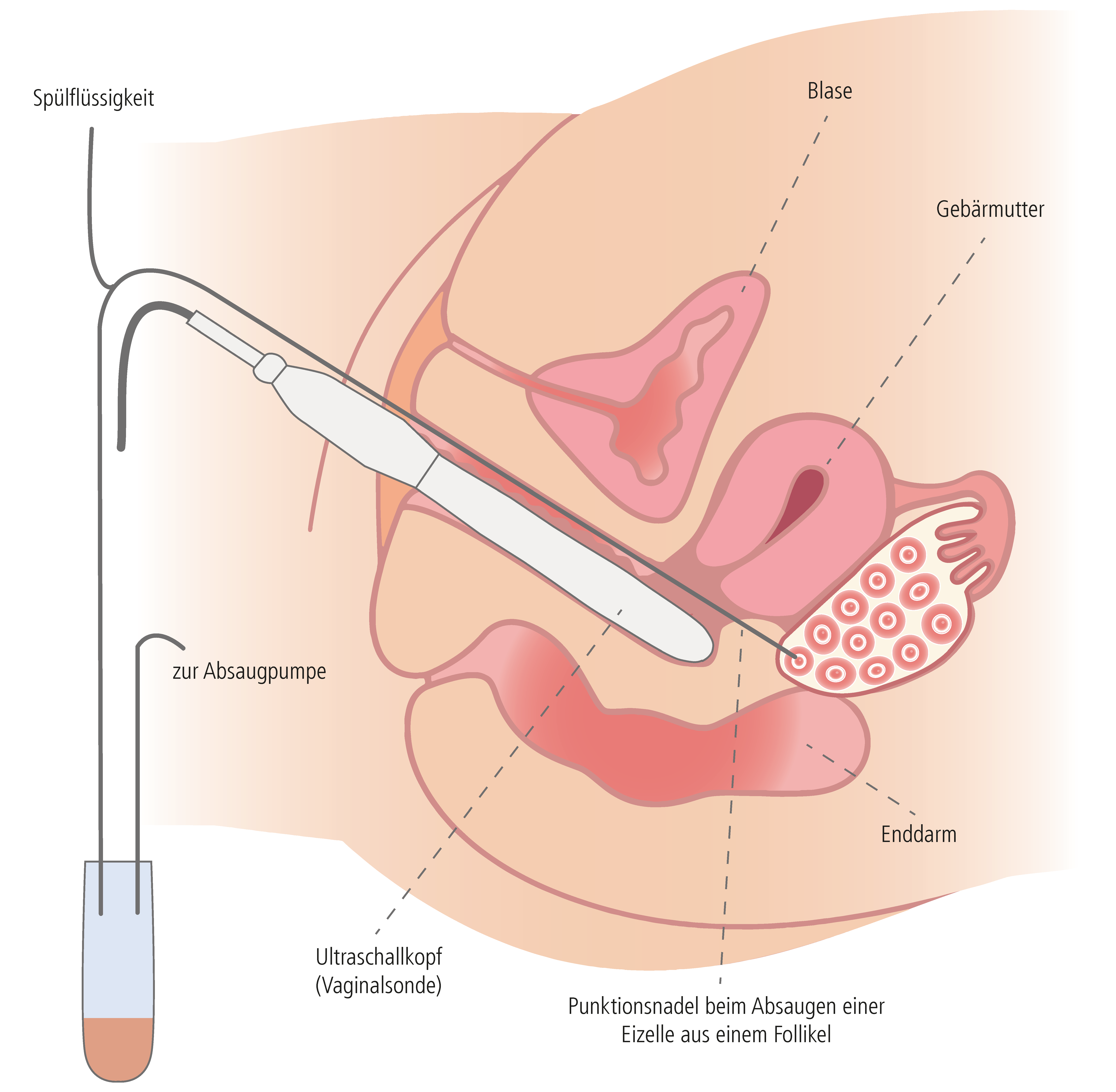 Schematische Darstellung der Eizellentnahme/Follikel-Punktion bei einer Kinderwunschbehandlung │ © 2021 Next Fertility IVF Prof. Zech