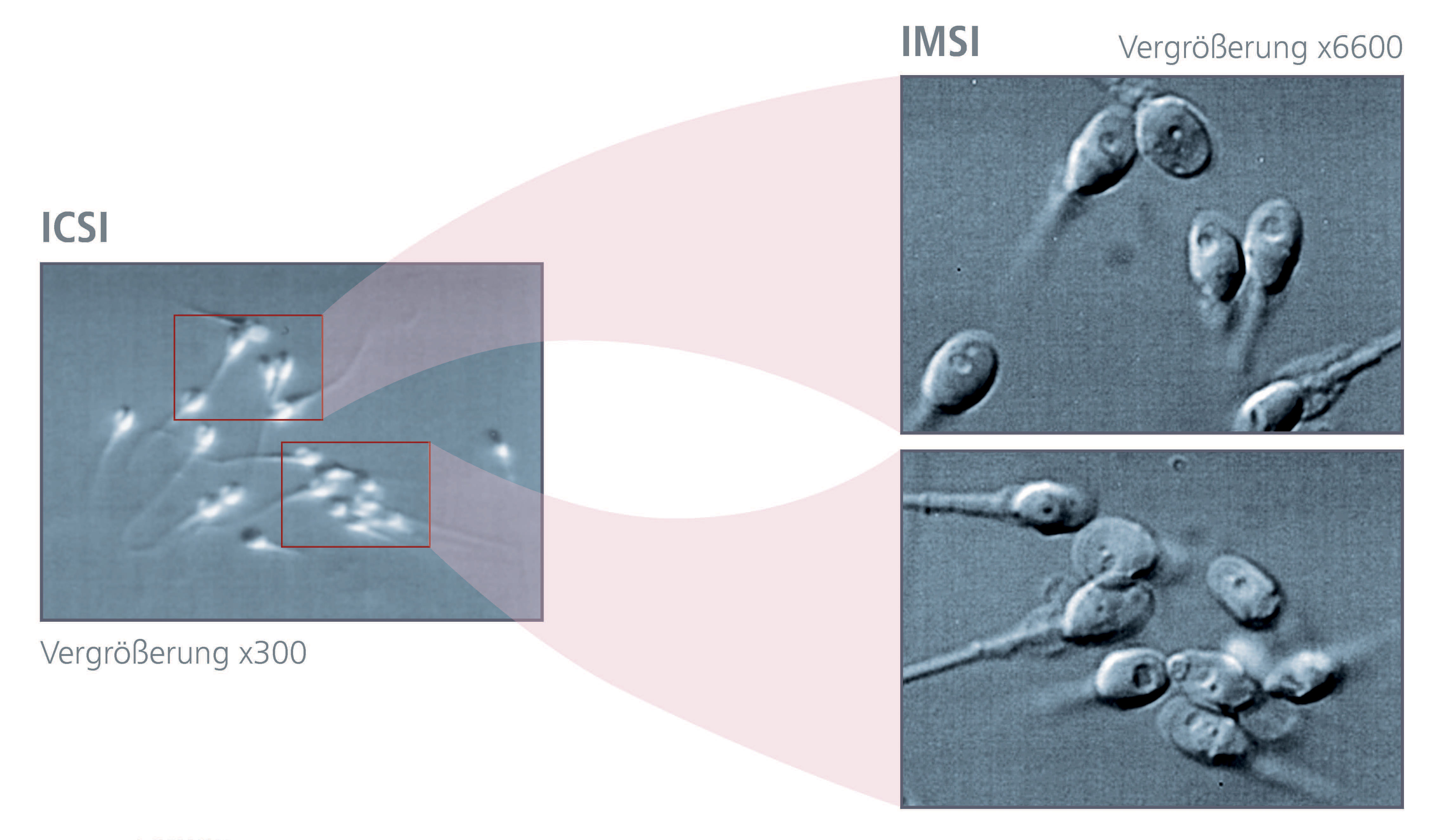 Illustration of the microscopic analysis and the procedure for selecting suitable sperm to be used for in vitro fertilization (IVF) of ova: Comparison of ICSI vs. IMSI │ © 2022 Next Fertility IVF Prof. Zech • Member of Next Clinics