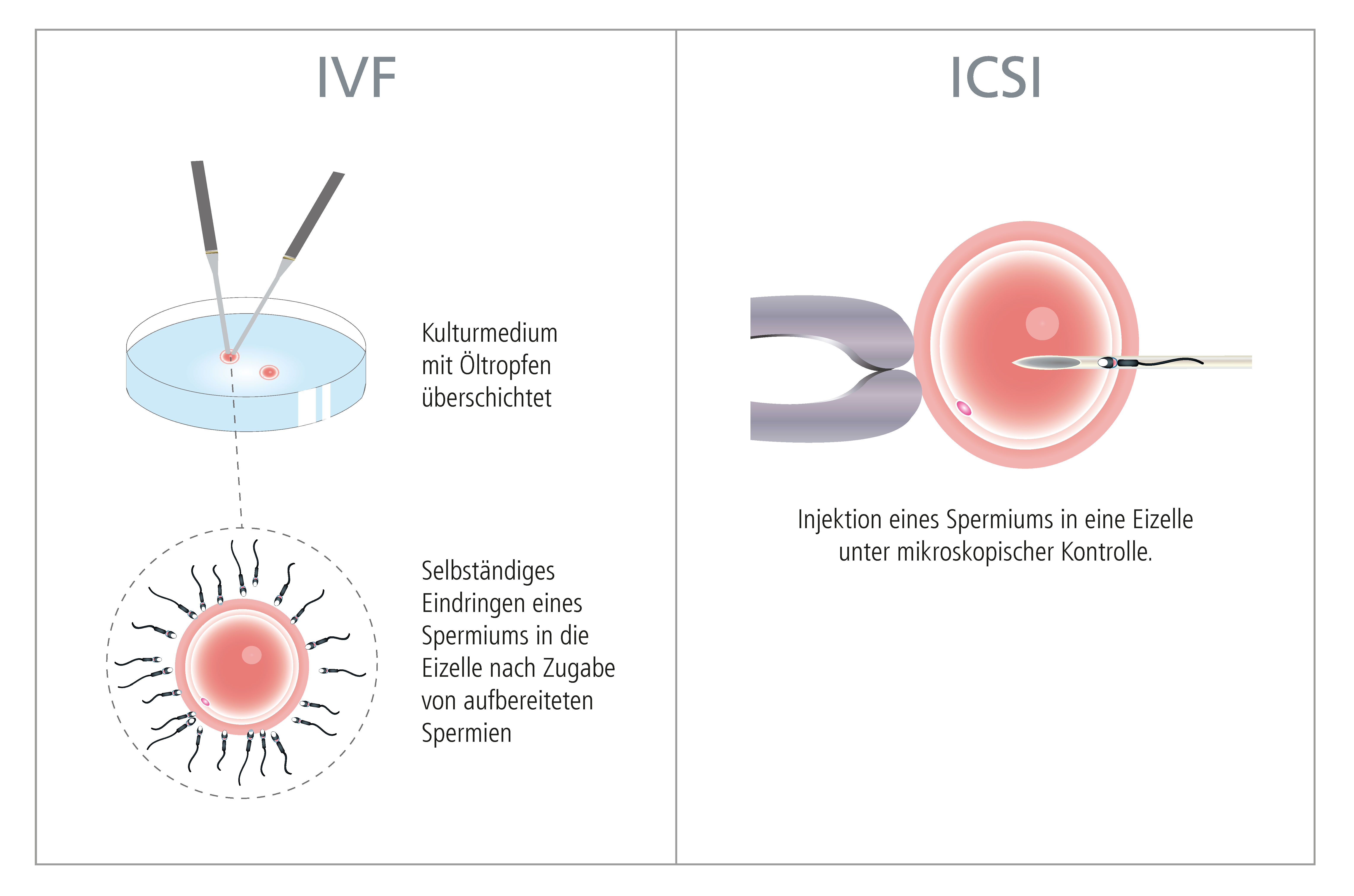 vergleich ivf icsi